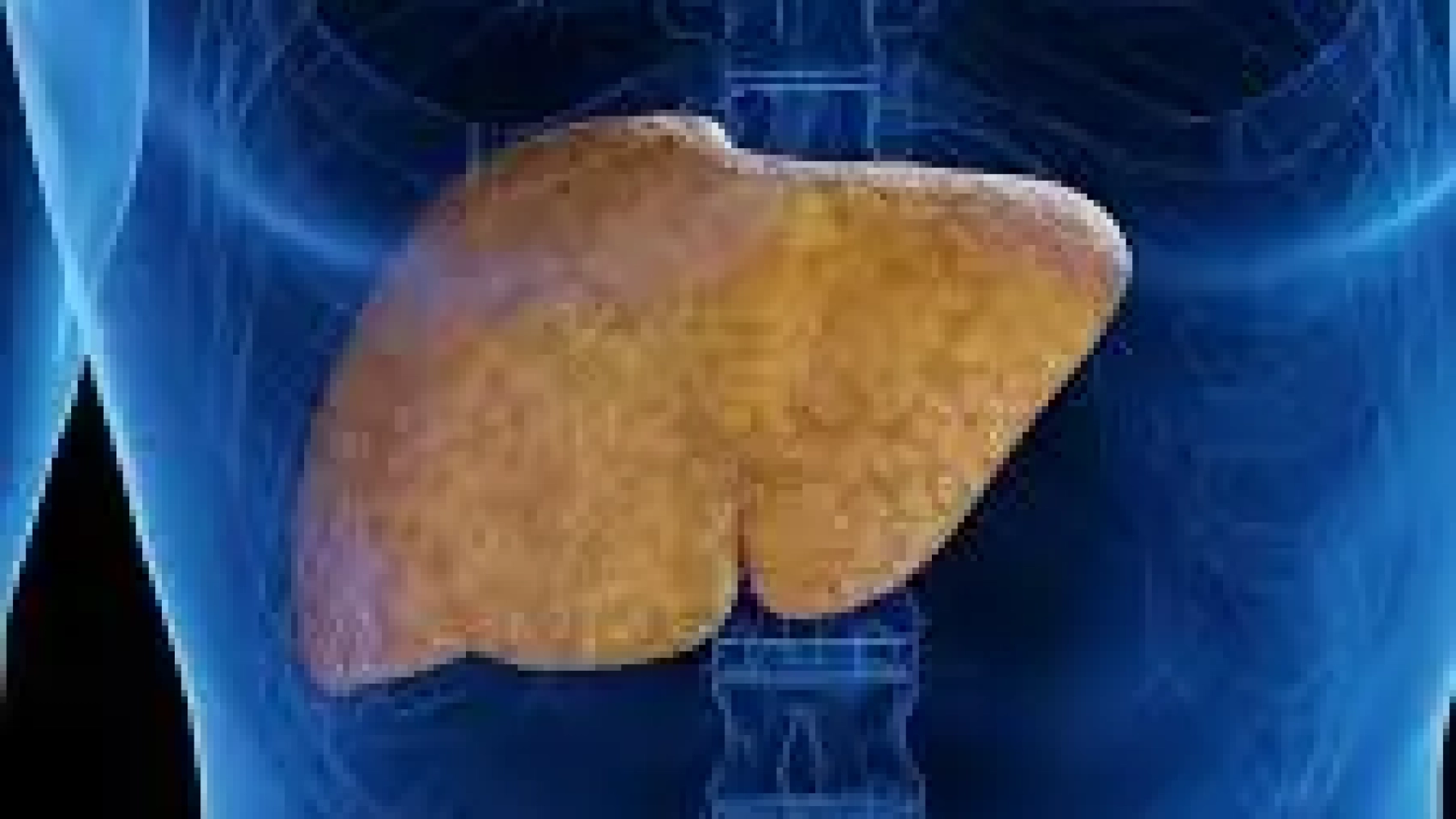 علاج الكبد الدهني